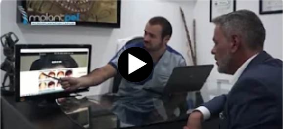 Trasplante capilar I Implantpel | Implantpel